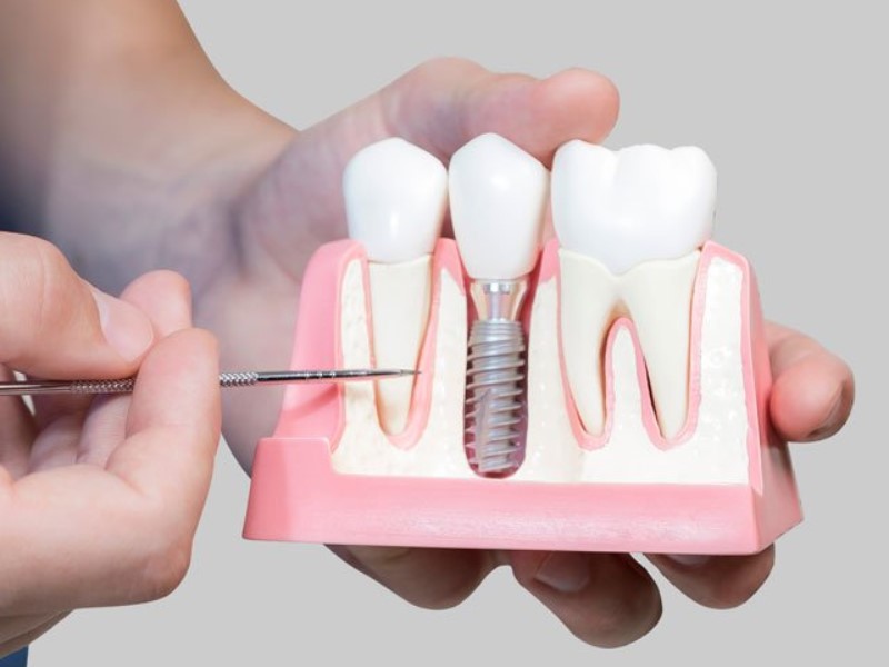 liječenje zuba i postavljanje zubnih implantata
