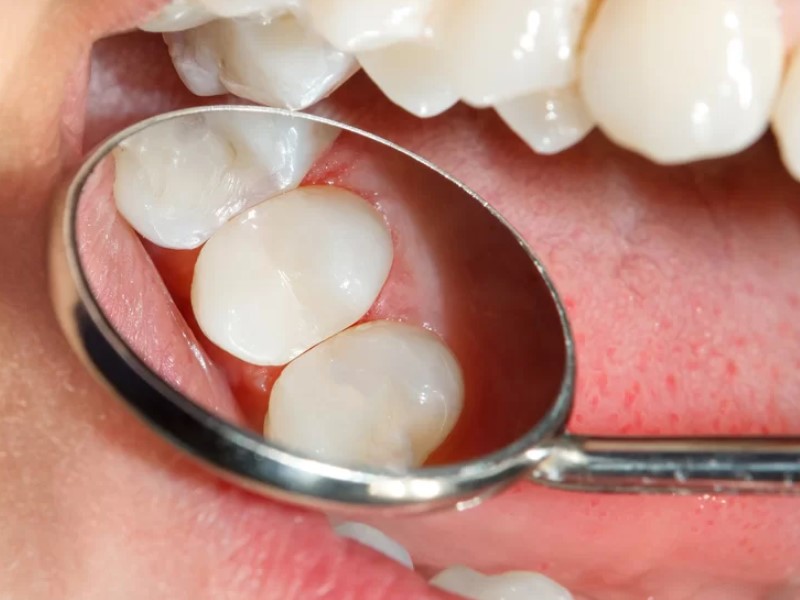 liječenje zuba postavljanjem zubnih ispuna